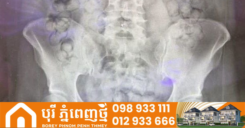 ‎ស្ត្រីជនជាតិថៃ លេបថ្នាំញៀនហេរ៉ូអ៊ីន ៧២គ្រាប់ចូលក្នុងពោះ ត្រូវបានរកឃើញ និងចាប់ខ្លូននៅតៃវ៉ាន់ 